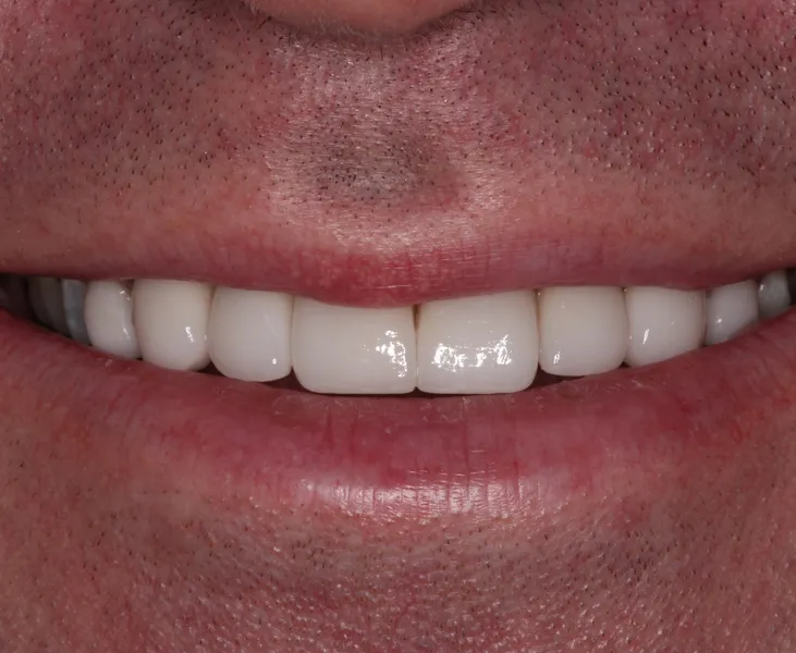 kai-dental-porcelain-veneers-january-case-5-after