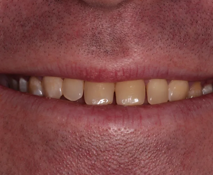 kai-dental-porcelain-veneers-january-case-5-before