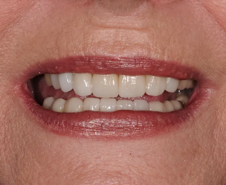 kai-dental-porcelain-veneers-july-case-15-after