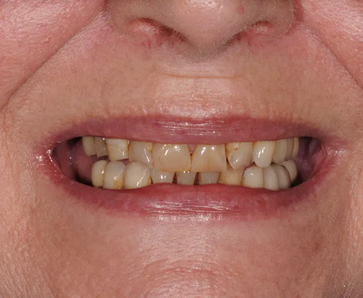 kai-dental-porcelain-veneers-july-case-15-before